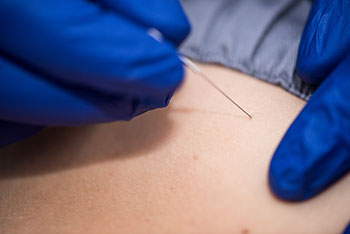 Dry Needling - Manual Physical Therapy