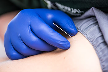 Dry Needling 2 - Manual Physical Therapy